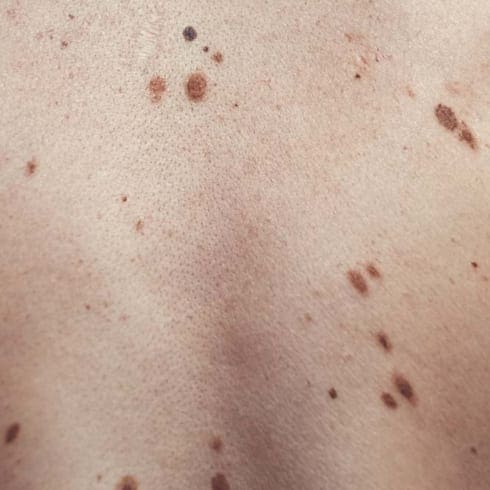 Skin Lesions