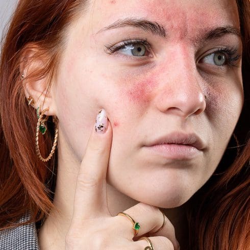 Rosacea