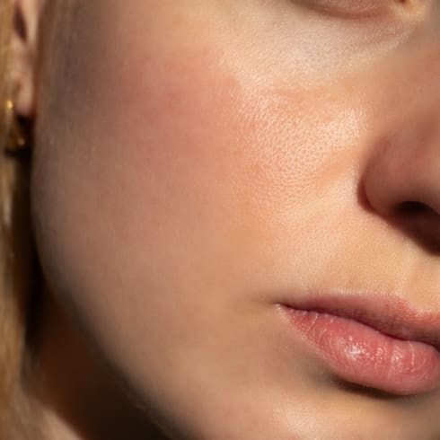 Rosacea Treatment