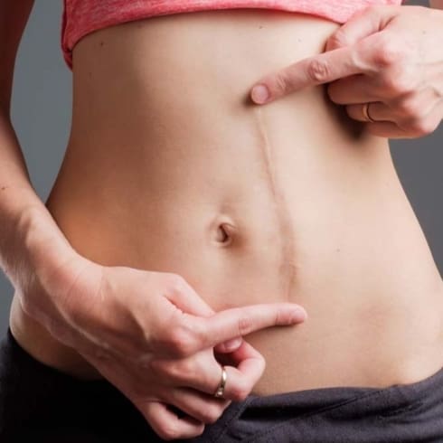 Steroid Injections